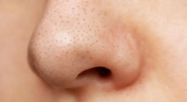 Skóra nosa z widocznymi porami. Ten **acne krem na niedoskonałości z lha i jonami srebra** może pomóc w walce z problemami skórnymi.