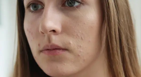 Skóra młodej kobiety z widocznymi pryszczami. Czy sudocrem jest dobry na pryszcze? To pytanie nurtuje wiele osób z problemami skórnymi.