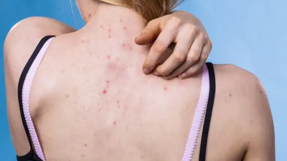 Pryszcze na plecach: Skuteczne sposoby na pozbycie się ich raz na zawsze